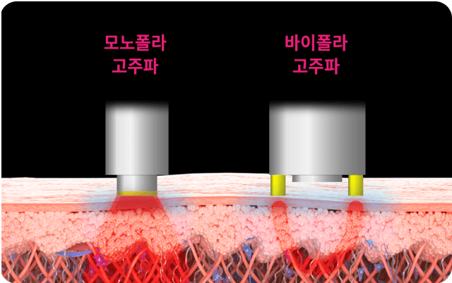 단극성 고주파 에너지 사용